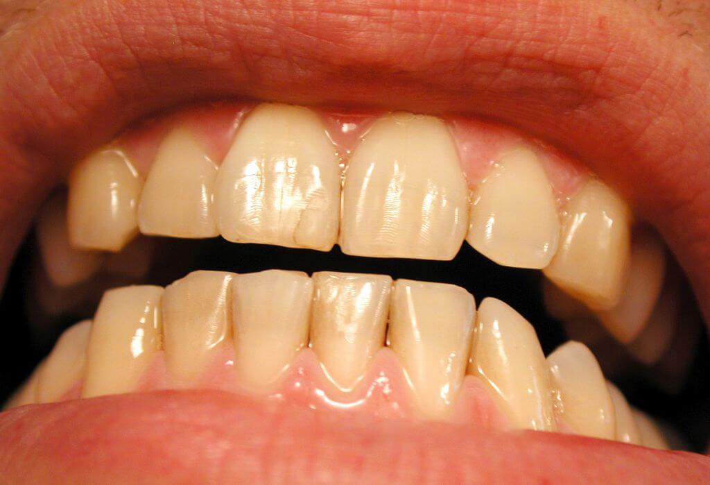 Yellow Teeth After Braces? Orthodontics in London